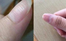 指甲凹陷是什么病的前兆-指甲盖凹陷修复方式图解