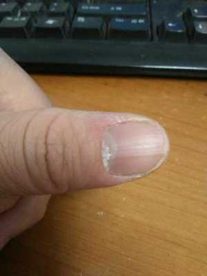 指甲盖掉了有什么征兆 指甲盖掉了要怎么修复-图2