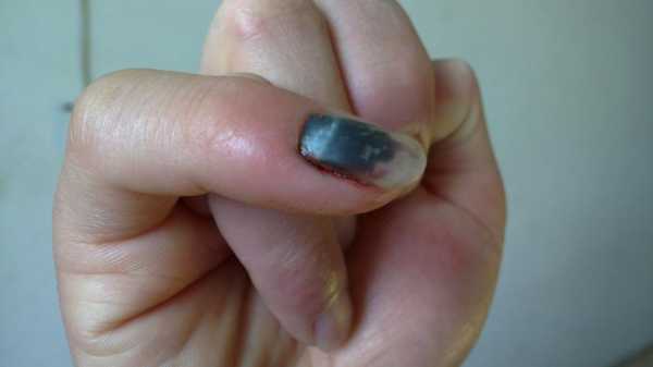 指甲盖掉了有什么征兆 指甲盖掉了要怎么修复-图1
