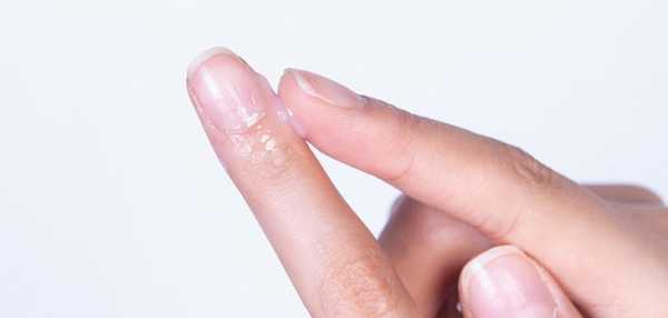 指甲周边怎么护理-手指甲周边皮肤修复-图3